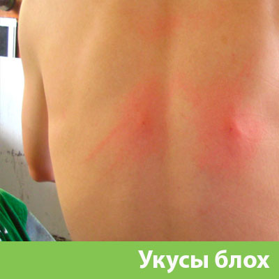 Укусы блох в Искитиме