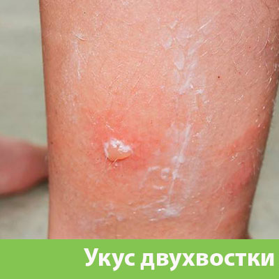 Укус двухвостки в Искитиме