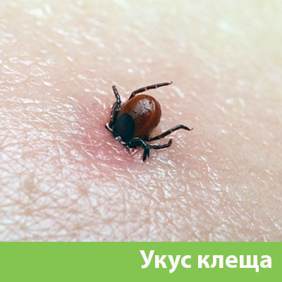 Укус клеща в Искитиме