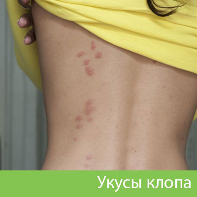 Профессиональное уничтожение клопов в Искитиме